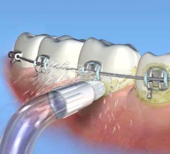 Orthodontics Study: Single blind, parallel clinical study 3 Conclusion: Dental water jet reduces plaque and bleeding in clients with fixed orthodontic appliances 106 subjects randomly assigned to 1