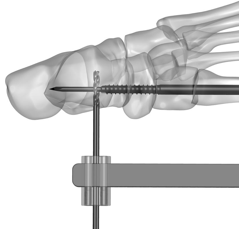 Verify the position of the Drill Pins with fluoroscopy in both the AP and lateral views.