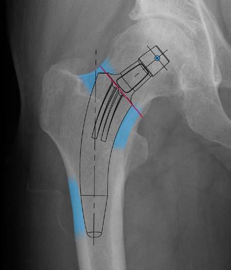 When using the M/L X-ray, proximal contact should be achieved posteriorly and anteriorly, and distal contact should be achieved posteriorly.
