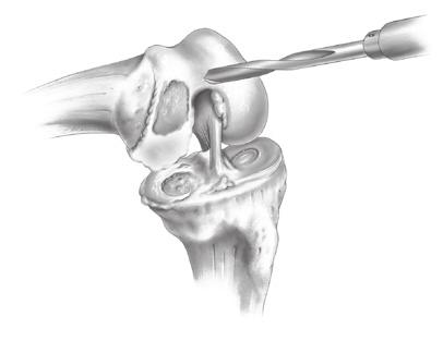 Intramedullary (IM) surgical procedure with spacer block option STEP ONE: DRILL HOLE IN DISTAL FEMUR Without everting the patella, flex the knee 20-30 and move the patella laterally.