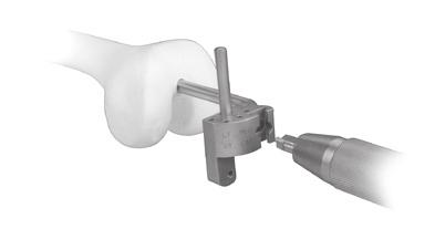 Intramedullary (IM) surgical procedure with spacer block option Using the Universal Handle, insert the appropriate IM Femoral Resection Guide into the femur (Fig. 7).