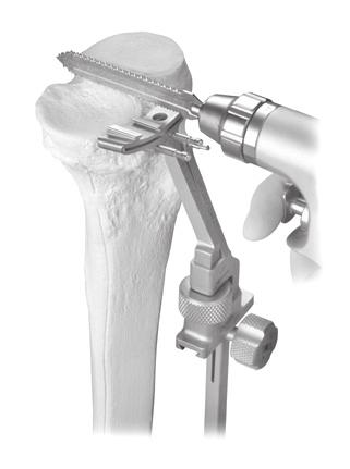 Intramedullary (IM) surgical procedure with spacer block option Seat the screw/pin that was inserted into the Tibial Resector Base.