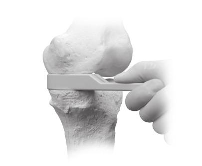Intramedullary (IM) surgical procedure with spacer block option STEP FOUR: CHECK FLEXION/EXTENSION GAPS To assess the flexion and extension gaps, different Flexion/ Extension Gap Spacers are