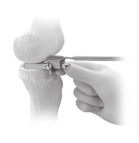 This ensures that the distal femoral resection is made perpendicular to the long axis of the femur.