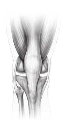 Extramedullary (EM) Surgical Procedure Incise the joint capsule in line with the skin incision beginning just distal to the vastus medialis muscle and extending to a point distal to the tibial