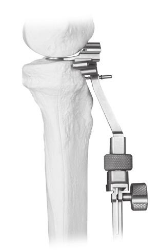Extramedullary (EM) Surgical Procedure In the sagittal plane, align the assembly so it is parallel to the anterior tibial shaft (Fig.