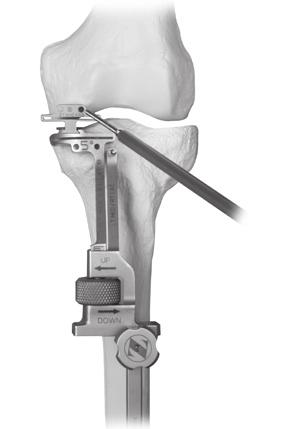 Extramedullary (EM) Surgical Procedure While maintaining this corrected position, use the thumb screw on the Tibial Resector Base to move the cutting guides superiorly until the paddle on the Distal