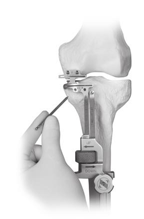 Extramedullary (EM) Surgical Procedure Secure the Tibial Resector to the proximal tibia by predrilling and inserting Gold Headless Holding