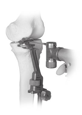 Extramedullary (EM) Surgical Procedure STEP THREE: RESECT THE DISTAL FEMORAL CONDYLE Insert a retractor medially to protect the medial collateral ligament. Using a narrow, 1.27mm (0.