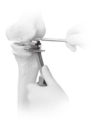 To avoid damaging the posterior popliteal area, do not extend the saw blade beyond the posterior margin of the femoral condyle while the knee is in extension.