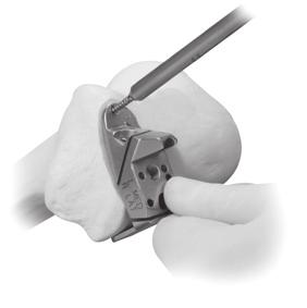 Extramedullary (EM) Surgical Procedure STEP SEVEN: FINISH THE FEMUR The following order is recommended to maximizethe stability and fixation of the Femoral Sizer/Finishing Guide.