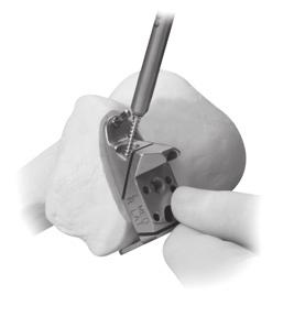 Extramedullary (EM) Surgical Procedure 2. Insert one 33mm Headed Screw (gold head) into the angled anterior pin hole, which is parallel to the chamfer cut (Fig. 26).
