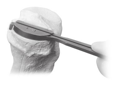 Pull the Tibial Sizing Slider anteriorly until the hook on the tip of the slider