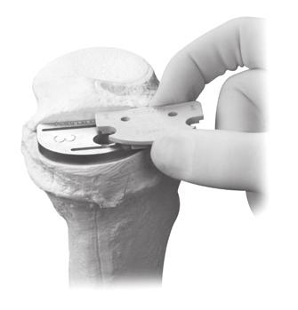 Extramedullary (EM) Surgical Procedure To help guide the femoral provisional past the patella, place the leg in deep flexion to begin the insertion. Insert the long post first.