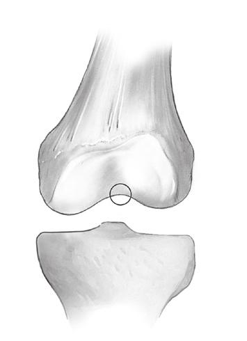 Intramedullary (IM) surgical procedure with spacer block option The angle of the distal femoral cut determines the contact point of the femoral component on the tibia (Fig. 3).