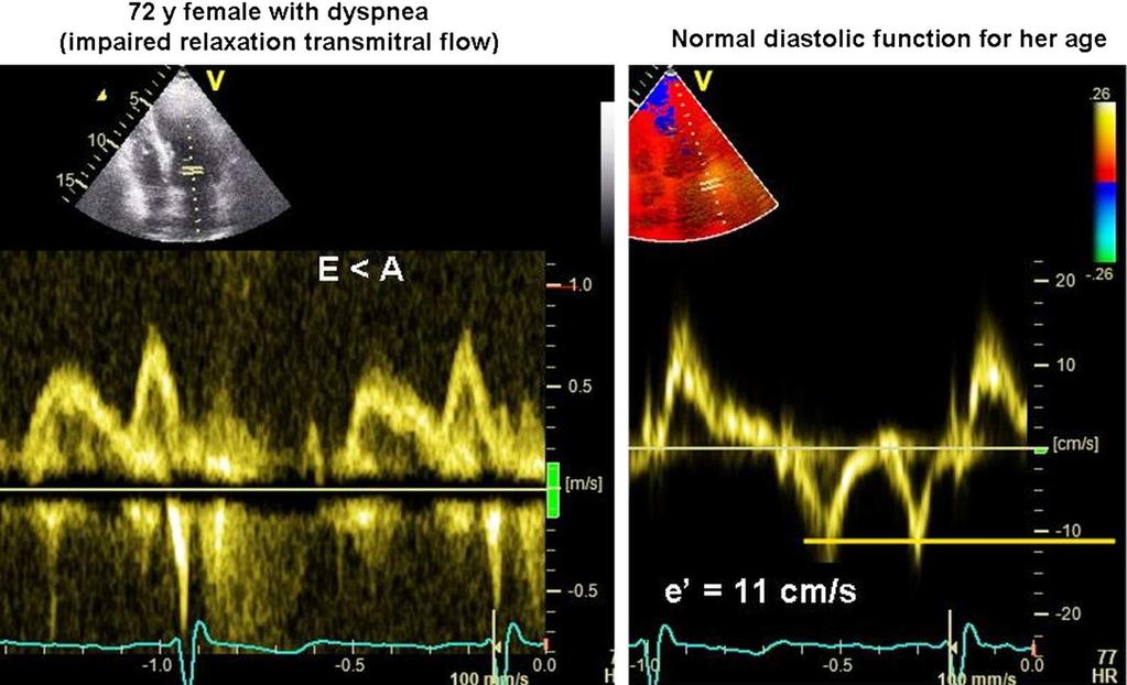 Impaired relaxation pattern (E < A) with corresponding tissue Doppler