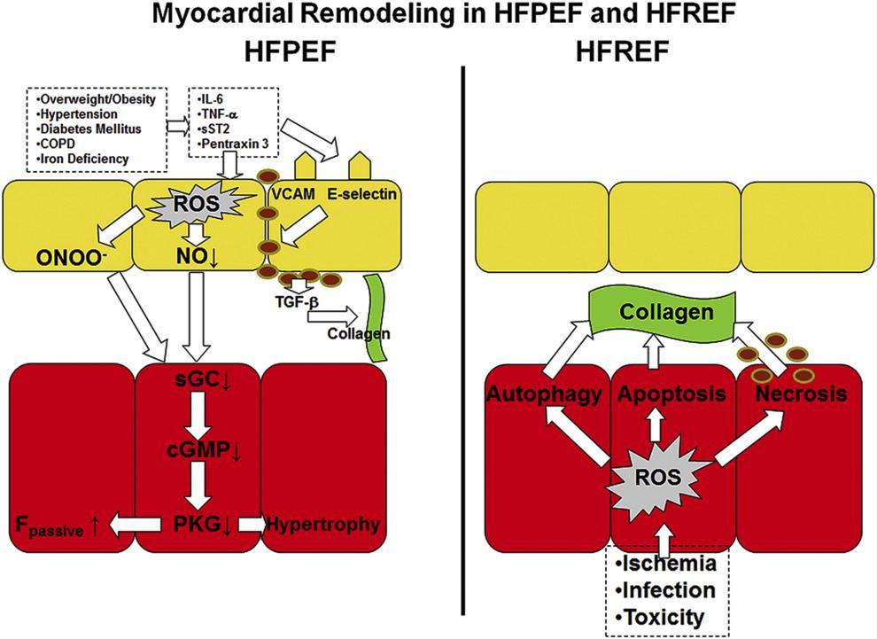From: A Novel Paradigm for Heart Failure With Preserved Ejection Fraction: Comorbidities Drive Myocardial Dysfunction and Remodeling Through Coronary Microvascular Endothelial Inflammation J Am Coll