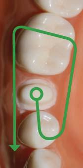 Note: For multiple anteriors and full arch cases, many operators use a saddle pattern to roll back and forth over the straight and long anterior teeth.