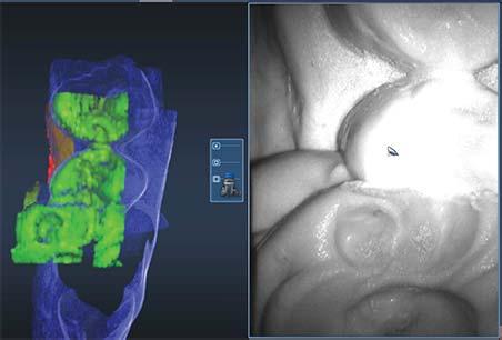 8. Activate the wand and begin the scans with the occlusal of one of the proximal teeth.