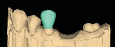 Designing the Bridge With any multiples case, it is generally best to start the Autogenesis process on a tooth with an existing neighbor.