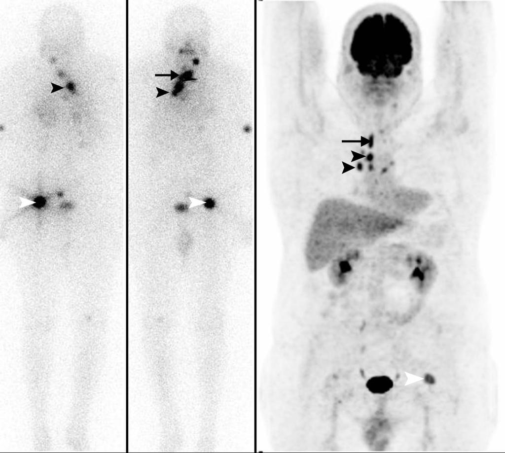 57-year-old man with papillary thyroid cancer.