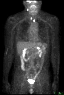 Pet scan for Thyroid Cancer When?