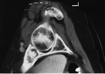 Malawer Chapter 28 22/02/2001 08:54 Page 425 Periacetabular Resections 425 A B D C Figure 28.1 Periacetabular chondrosarcoma.