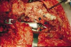 (B) Intraoperative photograph demonstrating the creation of the deep notch (large arrows).