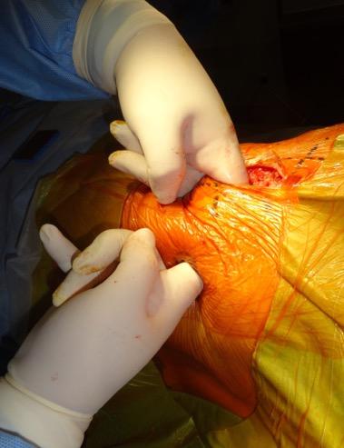 Confirming the retroperoneal area by touch, inserting finger into the