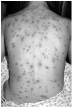Chickenpox Spots and Pox: Contact Tracing and Follow Up for Measles and Chickenpox Noelle Bessette, MPH Surveillance Specialist New Jersey Department of Health Vaccine