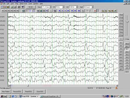 EEG workshop Epileptiform abnormalities Paroxysmal EEG activities ( focal or generalized) are often termed epileptiform activities EEG hallmark of epilepsy Dr.