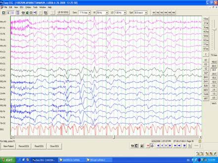 Generalized periodic epileptiform discharges ( GPEDs) Periodic short-interval diffuse discharges (PSIDDs)* Periodic long-interval diffuse discharges (PLIDDs)*