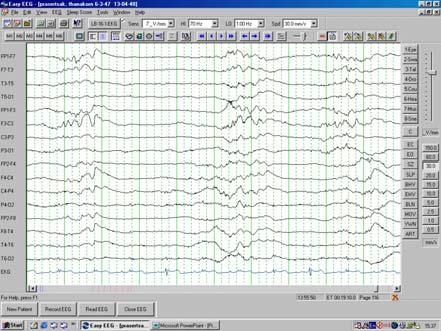complete flatness lasting 2 s to many minutes Topography : bilateral Rate of seizures : rare