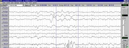 2 or more spikes associated with one or more slow waves Ictal discharges
