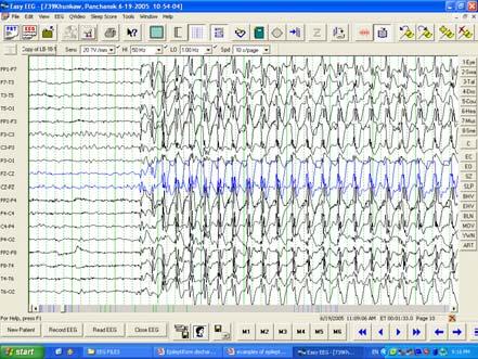 Localized epileptiform activity Recurrent focal ictal discharges are usually seen in status epilepticus; if without clinical seizure manifestations : subclinical electrographic status epilepticus