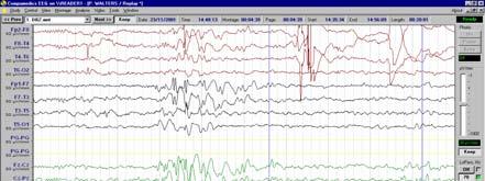 Hz, 4-5 Hz ) Slow GSW - closely related to the classic 3 Hz spike wave