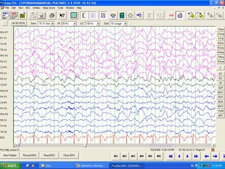 Bilateral periodic lateralizing epileptiform discharges ( BIPLEDs)