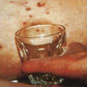 Watch out for meningitis and septicaemia The glass test Firmly press the side of a clear drinking glass against the rash so that you can see if the rash fades and loses colour under pressure.