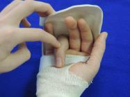 AROM Exercise orthosis hand based DIPJ flexion