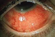 Scleritis LEN V KOH OD 2014 PUCO 1 Introduction A painful, destructive, and potentially blinding disorder Highly