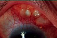 anterior scleritis 2014 PUCO 31 Cardinal features Conclusions Risk of losing sight Ocular comorbidities