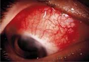 Scleritis: Diffuse vs Nodular DIFFUSE ANTERIOR SCLERITIS Widespread ocular erythema Scleral edema NODULAR ANTERIOR SCLERITIS Localized area