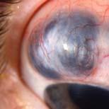 scleritis Severe ocular and periorbital pain Intense vasodilatation of deep episcleral plexus Thinning of the sclera Peripheral ulcerative