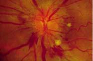 Posterior scleritis Diplopia T Sign Pain upon eye