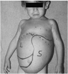 tissue damage Symptomatically diverse Many different organ systems involved Usually not apparent at birth Signs and symptoms develop progressively Variable age of onset Gaucher Disease Deficiency