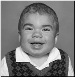 Enzyme replacement therapy is available Hunter Syndrome (MPS II) Iduronate-2-sulfatase deficiency X-linked disorder Similar features to Hurler