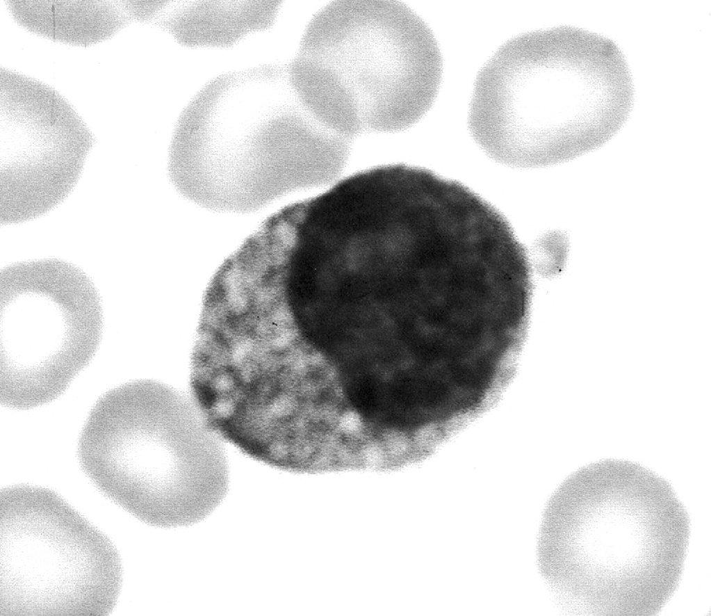 Figure 1 A lymphocyte with many vacuole-like inclusions (original magnification, x900).