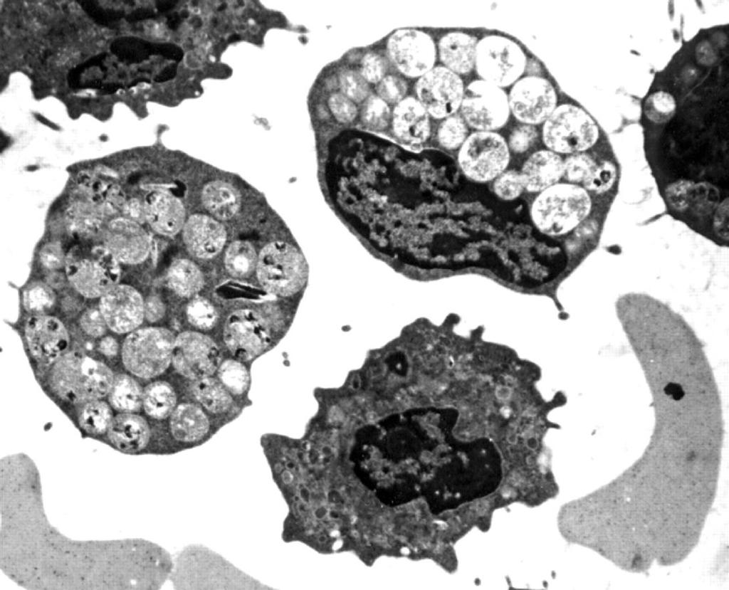 Figure 3 Electron microscopic image of lymphocytic vacuoles containing round osmiophilic structures (original