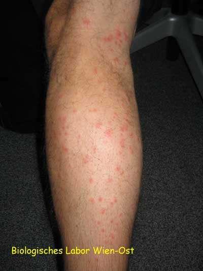 CERCARIAE PENETRATE SKIN ITCHY MACULO-PAPULAR RASH ON