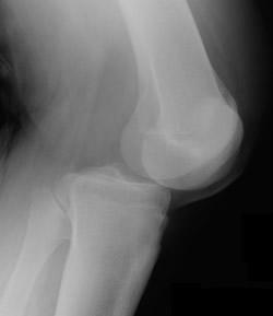 flexed knee (dashboard injury)